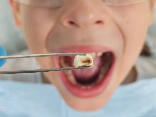 Best Emergency Treatment for Dental Infections or Abscesses in Taylor Creek, OH